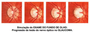glaucoma 9